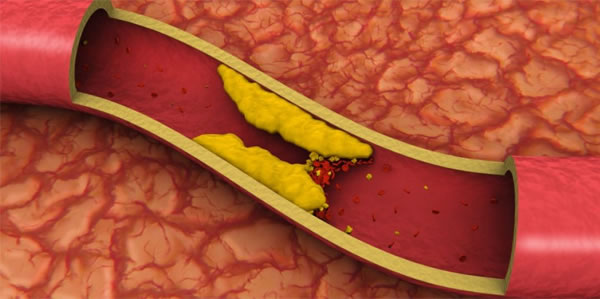 colesterol gordura no sangue