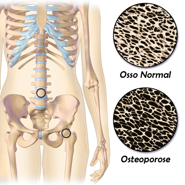 Osteoporose, imagem comparativa de ossos