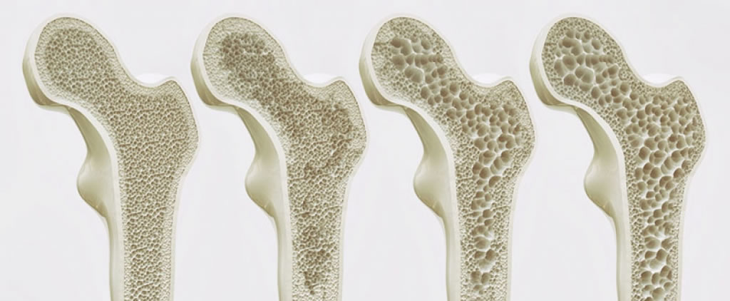 Osteoporose, imagem de vario ossos para comparacao