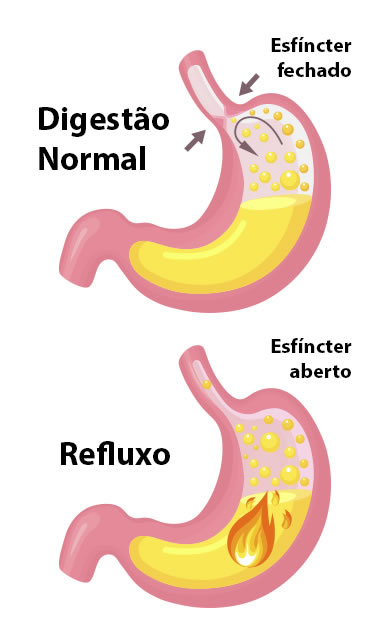 Como funciona o refluxo