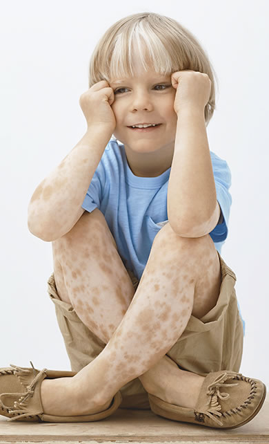 Menino crianca com vitiligo