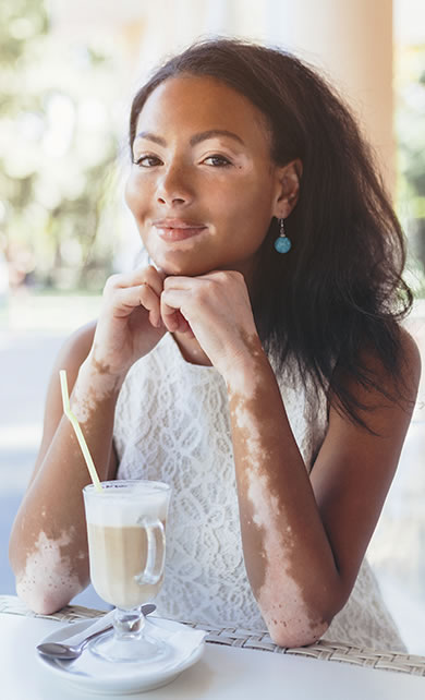 Mulher negra com vitiligo