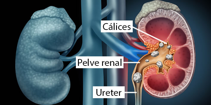 Como forma a pedra no rim