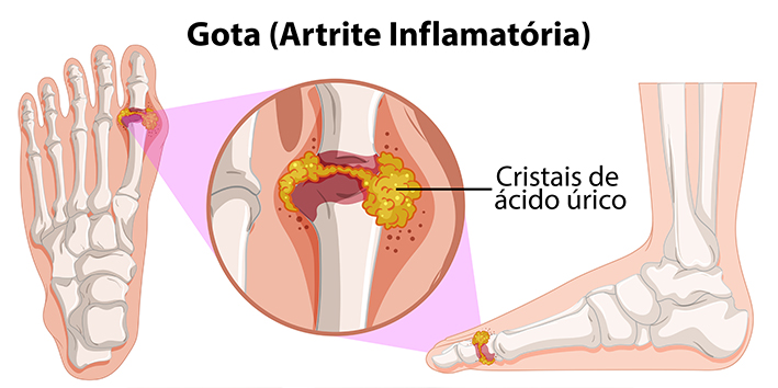 Como funciona a gota