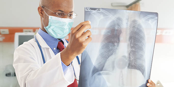 Medico olhando exame fibrose pulmonar sequela