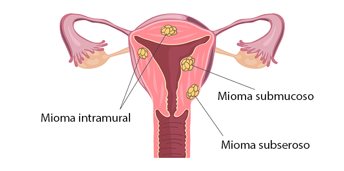 Tipos de miomas uterinos