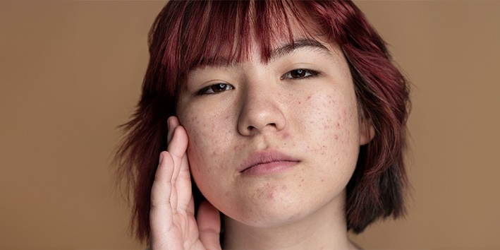 Saude da pele acne Saude da pele acne