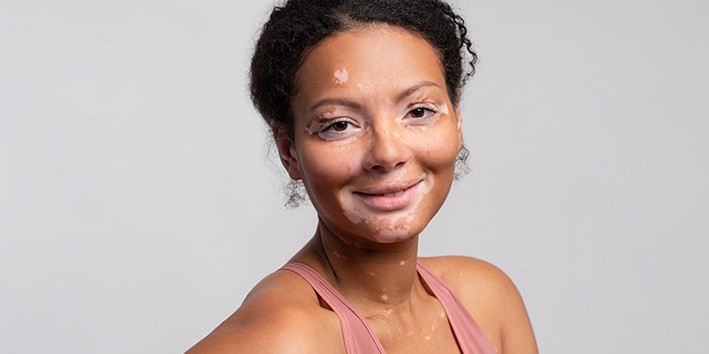 Centella asiatica na estetica vitiligo Centella asiatica na estetica vitiligo