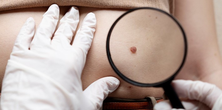 Thuya indicacao verruga uso topico Thuya indicacao verruga uso topico