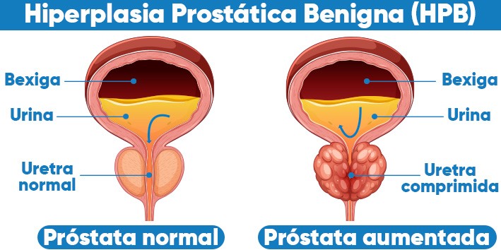 Pygeum africanum Para que serve extrato seco composicao