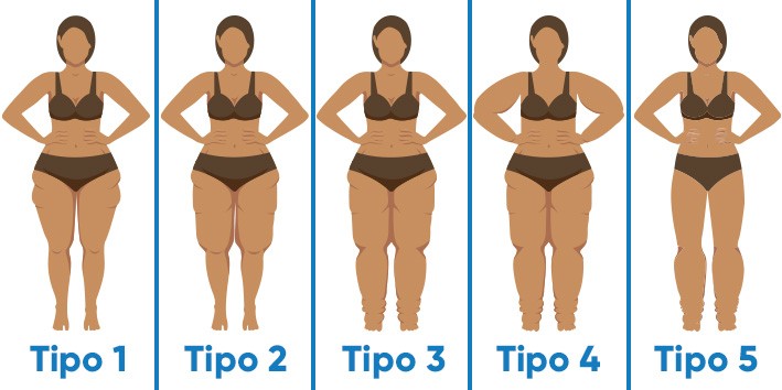 Lipedema tipos