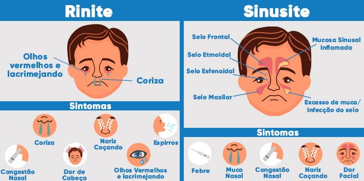 spray-nasal-rinite-sinusite spray-nasal-rinite-sinusite